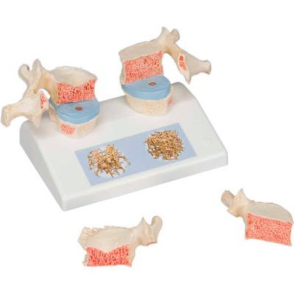 Fabrication Enterprises 3B® Anatomical Model - Osteoporosis Model 966038